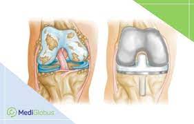 Cost Of Knee Replacement And Recovery Abroad Mediglobus