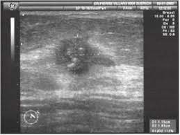 Brustkrebs Gynecologie Dufour Dr Med Pierre Villars