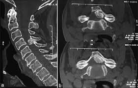 It is an extremely elastic ligament, which connects the spinal bones through its two laminae, articular joints. Ossification Of The Cervical Ligamentum Flavum And Case Report With Myelopathy Surgical Neurology International