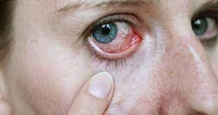 What Are The Causes And Symptoms Of Pink Eye