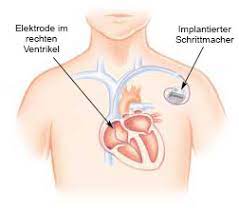 Ein herzschrittmacher wird eingesetzt, wenn die selbstregulation des herzrhythmus gestört ist. Herzschrittmacher Wissen Ablauf Nachsorge Tipps