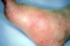Charcot foot is a condition causing weakening of the bones in the foot that can occur in people who have significant nerve damage (neuropathy). The Charcot Foot In Diabetes Six Key Points American Family Physician