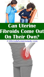 Large Fundal Fibroid Uterine Fibroids Fibroids Ovarian Cyst Surgery