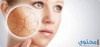 Check spelling or type a new query. Ù…ÙˆÙ†Ø¯Ùˆ ÙƒØ±ÙŠÙ… Mondo Cream Ù„Ø¹Ù„Ø§Ø¬ Ø¬ÙØ§Ù Ø§Ù„Ø¨Ø´Ø±Ø© Ù…ÙˆÙ‚Ø¹ Ù…Ø­ØªÙˆÙ‰