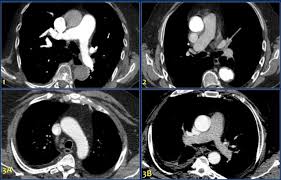 Image result for CT Intravenous Contrast