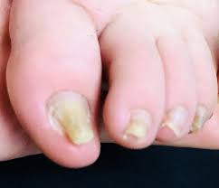 爪の色が茶色の原因 | ブログ | 宇都宮のフットケアなら健康美容のサロン ハレとケ