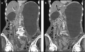 Katakura Used to drain obstructed biliary ducts. katakura