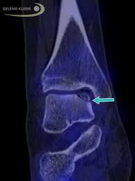 That is the first symptom of an od. Osteochondrosis Dissecans Od Im Sprunggelenk Gelenk Klinik De