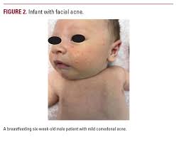 The Many Faces of Pediatric Acne: A Practical Algorithm for Treatment,  Maintenance Therapy, and Skincare Recommendations for Pediatric Acne  Patients