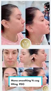 #monopdothread Vs #cogpdothreads #facelift #pdothreadlift #fatdissolving  #losalamitos #cerritos #longbeachca #buenapark