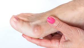 What does a Bunion look like and How It Appears on Feet