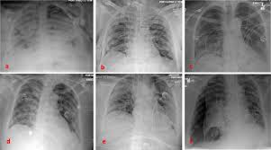 Is collapsed lung symptoms your major concern? Pneumothorax In Covid 19 Disease Incidence And Clinical Characteristics Respiratory Research Full Text