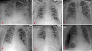 Bilateral simultaneous thoracotomy for unilateral spontaneous pneumothorax, with spetial referens to the. Pneumothorax In Covid 19 Disease Incidence And Clinical Characteristics Respiratory Research Full Text
