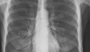 Image result for Emphysema
