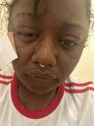 Living with sarcoidosis and rheumatoid arthritis