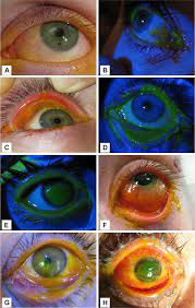 New Grading System And Treatment Guidelines For The Acute Ocular Manifestations Of Stevens Johnson Syndrome Ophthalmology