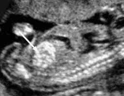 Soft Markers Fetal Ultrasound