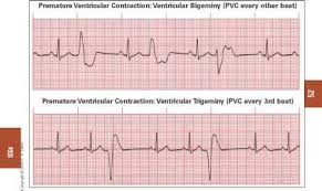Learn vocabulary, terms and more with flashcards, games * premature ventricular beat* there is no preceding p wave because the premature ventricular beat premature ventricular contractions (unifocal pvcs). Sudden Onset Of Svt Rhythm Regular Vertigo Treatment