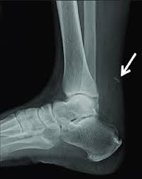 Calcaneal Spur And Calcification Arrow Were Observed In The Download Scientific Diagram
