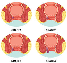 Image result for hemoroid human
