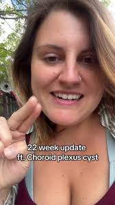 What Causes Fetal Choroid Plexus Cysts