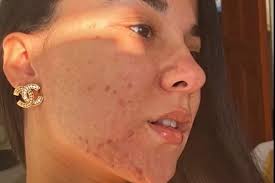 I was called pizza face but I've learned to love my skin'