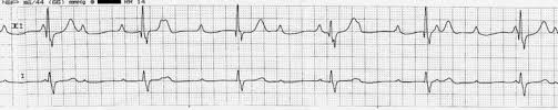 Intervalele pq > 0,2 sec 2. Atrioventricular Block Amboss