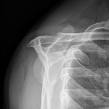 Perfil de giuseppe bigliani en engormix. Das Extrinische Impingement Der Schulter Schulterzentrum Saar Dr Gross