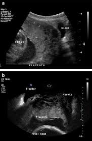 Since it can change over time, placenta positioning should be monitored throughout placental positioning is often checked between 18 and 21 weeks of pregnancy using an ultrasound. Ultrasound Of The Placenta A Systematic Approach Part I Imaging Sciencedirect