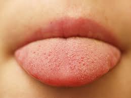 Maybe you would like to learn more about one of these? Swollen Tongue Symptoms Causes Treatments