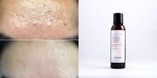 Acne Bio Oil Before After Pin On Acne Scar Removal