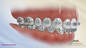 Read more about the risks of this dental condition and how to fix an overbite with braces, aligners, and/or surgery. Rubber Bands Ava Orthodontics Invisalign