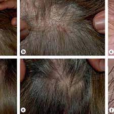 Although a clinical cause has not been determined, scientists believe that substance p, a neuropeptide made by. Pdf Red Scalp Disease A Rosacea Like Dermatosis Of The Scalp Successful Therapy With Oral Tetracycline