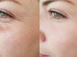 What does the micropen help? Micro Needling By Micro Pen Ibeauty Clinic Aesthetic Medical Spa