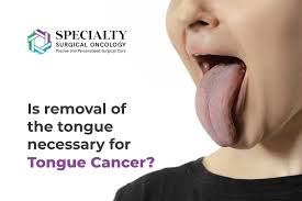 Image result for cancer of tongue