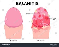 Image result for balanoposthitis