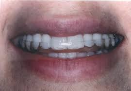 How long can you go without wearing a retainer? Ask Dr Spindel Will My Night Guard Or Retainer Still Fit After I Have A New Crown Placed