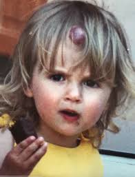 Molly-Mae Hague opens up about 'unfair and prominent' strawberry birthmark 