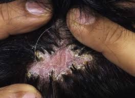 Image result for folliculitis symptoms