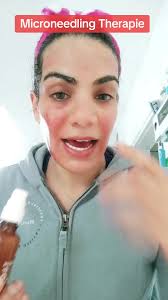 #Skincare #microneedlingtherapy #mesotherapy #fyp