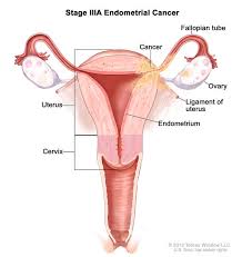 definition of stage iii endometrial cancer nci dictionary