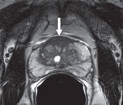 An mri can determine whether prostate cancer has … Mri Guided Prostate Biopsies Improve Cancer Detection