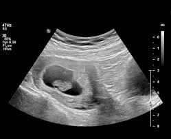 Fetal size and dating : First Trimester Radiology Reference Article Radiopaedia Org
