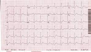 You can see that its movement pattern is repeated the same way across the entirety of the ekg strip. Accelerated Av Junctional Rhythm 75 Bpm With Right Bundle Branch Block Download Scientific Diagram
