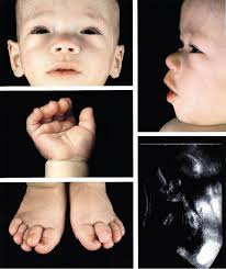 Leukocyte adhesion deficiency II syndrome, a generalized defect in fucose  metabolism