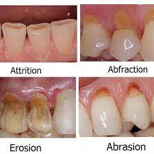 Dangerous Dental Care Logo Dentistrylife Dentalcarecavities Ugliest Tooth Extraction Swelling Dentistas Dental Anatomy Dental Hygenist Dental Hygiene School