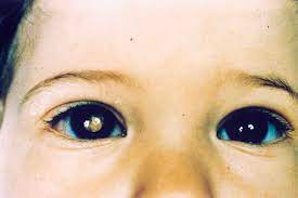Os primeiros sintomas que costumam aparecer são: Retinoblastoma Causas Sintomas E Tratamento Fabrica De Oculos Do Cacem
