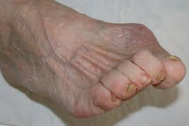 Image result for diabetic toes