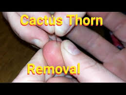 Ideally, when anything punctures and lodges itself in the skin, the only thing to do is to remove it from the skin. Removing 7 Week Old Cactus Thorn Youtube
