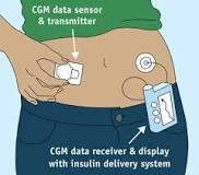 Image result for cgm